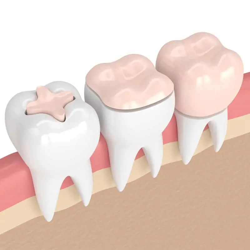 Mi a különbség a fogtömés és a fogbetét között? (x)